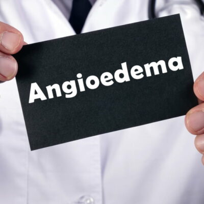 3 Warning Signs of Hereditary Angioedema and Management