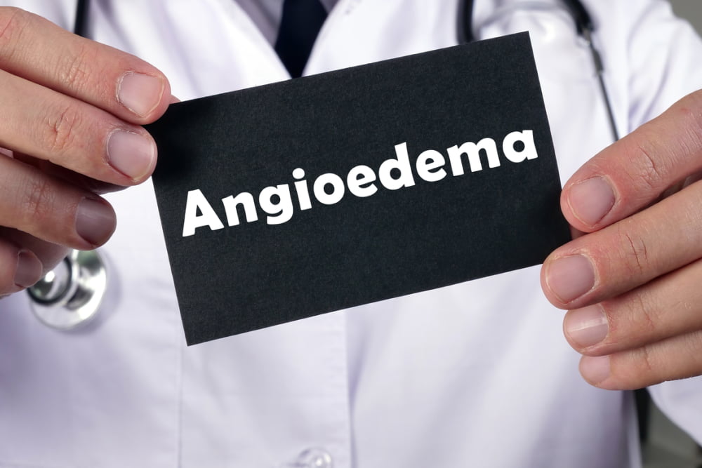 3 Warning Signs of Hereditary Angioedema and Management
